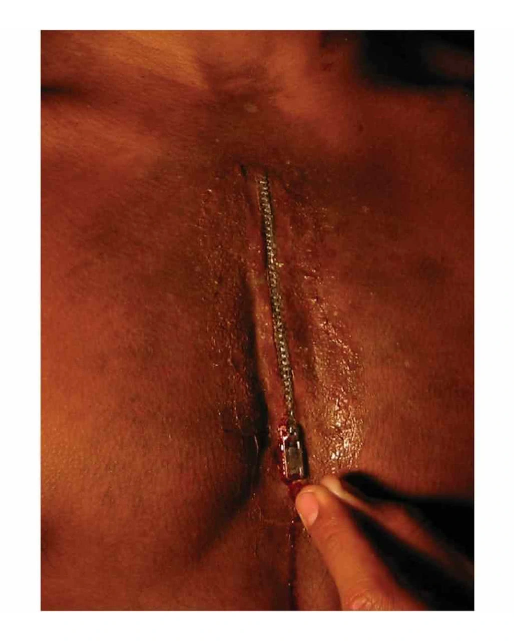 Realistische Reißverschlusswunde 3 Realistische Reißverschlusswunde